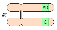 片方がcisAB型、もう一方がO型の例